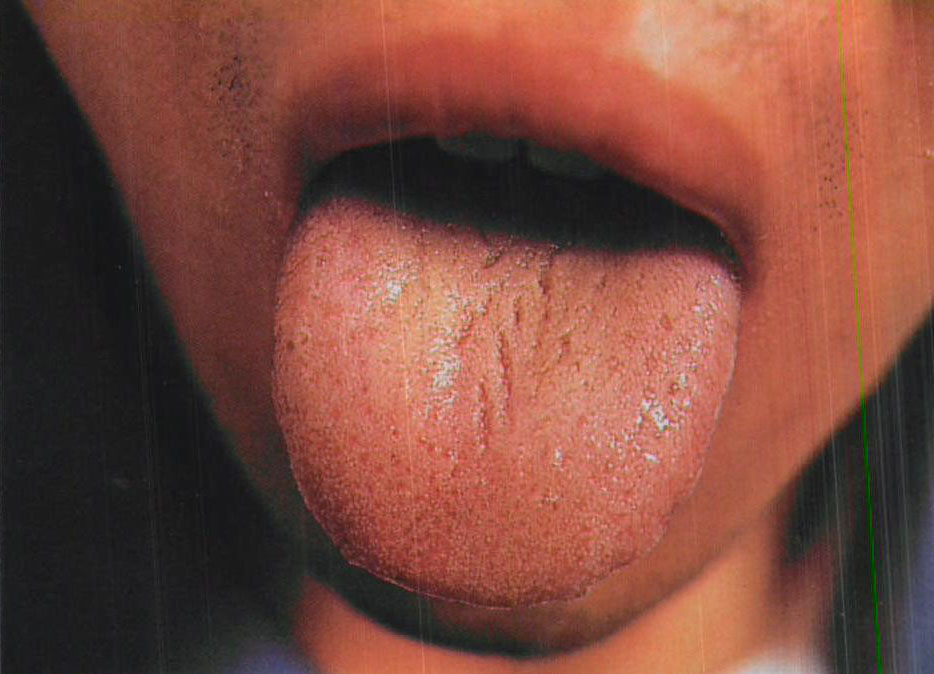 肝氣犯胃